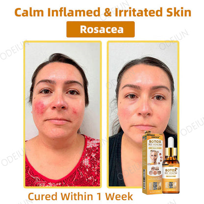 🎁Flash Sale - ODEIUN™ BOTOX Bee Venom Anti-Aging Serum - Suitable for all skin types🐝💎