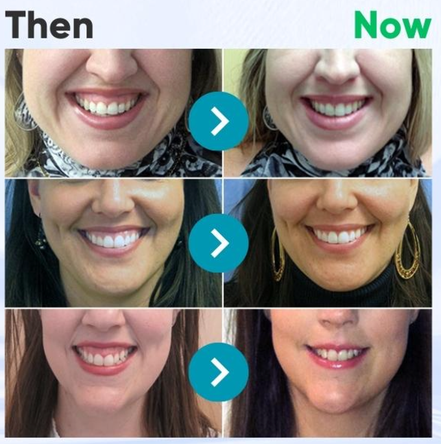 🏆Official Store |🧑🏽‍⚕️ODALIT™ Focussmile Bee Venom Treatment Oral Powder 🦷(ADA Recommended)